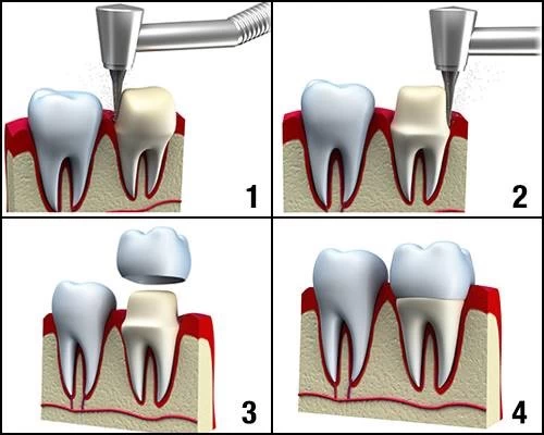 كيف تتم عملية الحصول على تاج من البورسلين